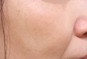 右頬の肝斑術後1カ月