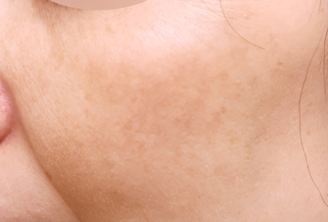 左頬の肝斑術前