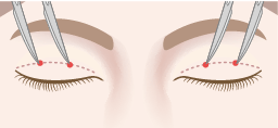 瞼縁から6.5~8mmの位置に片側2か所ずつ(両側4か所)、約1~2mmの皮膚切開