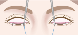 糸を結膜側(まぶたの裏側)から挙筋または瞼板に通す