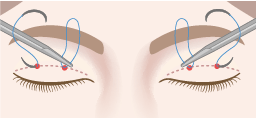 結膜側(まぶたの裏側)の同じ針穴から皮膚側に向かって糸を通す