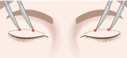 瞼縁から6.5~8mmの位置に片側2か所ずつ(両側4か所)、約1~2mmの皮膚切開