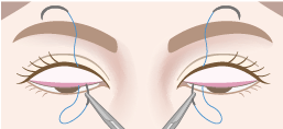 結膜側(まぶたの裏側)から挙筋または瞼板に通す
