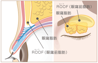 ルーフ（隔膜前脂肪）の解剖図