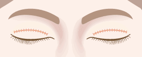眼窩脂肪除去術＋全切開による重瞼術3正面