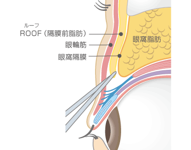 ROOF除去術＋全切開による重瞼術2断面