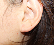 耳垂裂修正後耳表