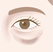目の下の凹みの解剖図イラスト：目の下の凹み（正面）