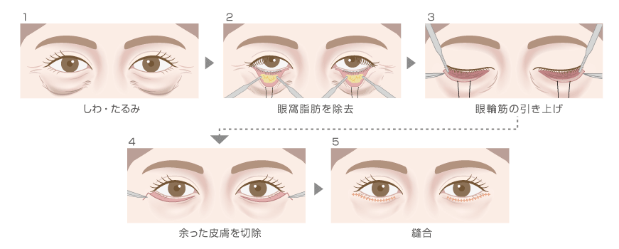 下眼瞼除皺術 クマ たるみ取り 脂肪含む ヒルズ美容クリニックは神奈川 湘南 藤沢の美容外科 美容皮膚科 形成外科